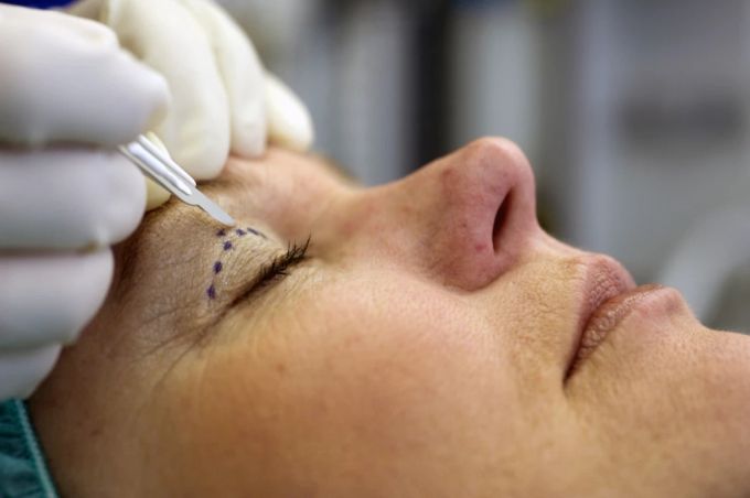 Seit den 1990er-Jahren lassen sich immer mehr Menschen mit Fillern wie Botox behandeln. (Symbolbild) face filler