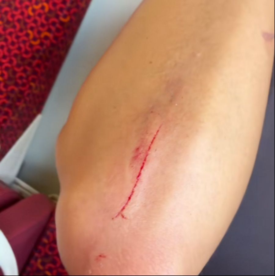 Influencerin Camila wurde beim Sturz in der Hose verletzt und zog sich einen aufgeschürften Arm zu.