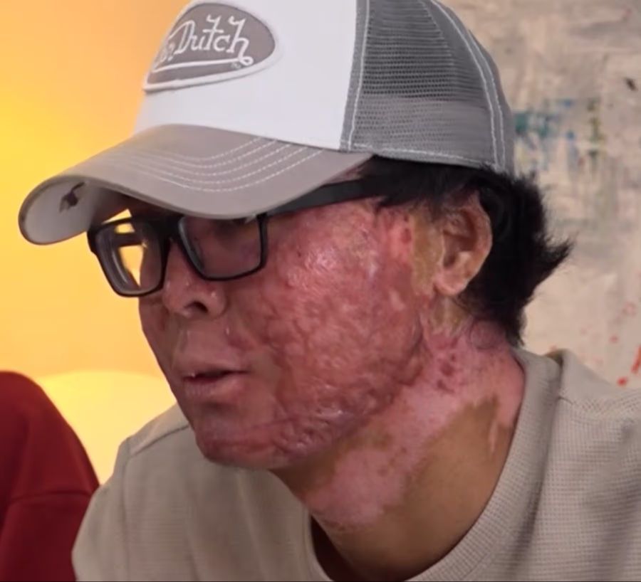 Der 17-jährige Kean hat tiefe Verbrennungen dritten Grades am ganzen Körper.