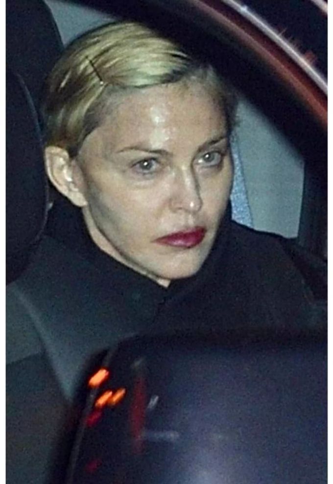 Vor einigen Monaten sorgte sich Fans schon um die Queen of Pop, nachdem sie mit geschwollenem Gesicht zu sehen war. madonna