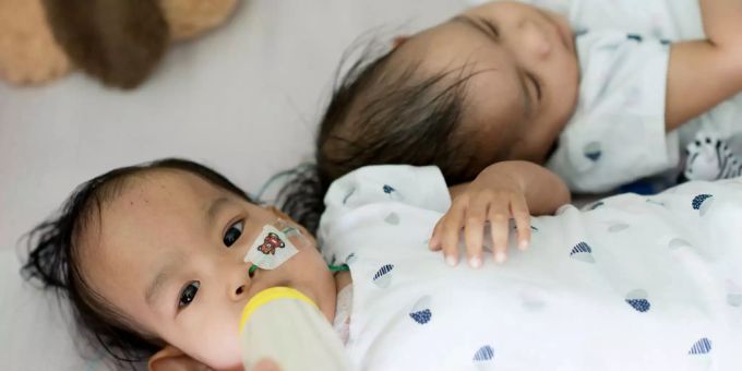 Müssen nicht länger in einem Spitalbett schlafen: Nima und Dawa. Die beiden getrennten, siamesischen Zwilling Nima und Dawa liegen in ihrem Spitalbett in Melbourne.