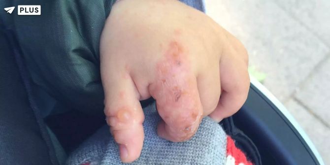 Hand-Mund-Fuss-Krankheit