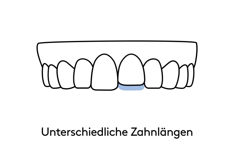 Das kann bestsmile mit Veneers korrigieren.