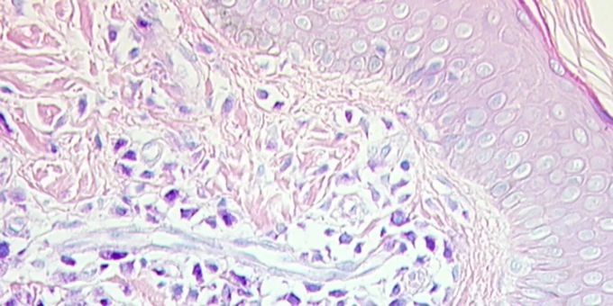 Gefärbter Gewebeschnitt der Haut eines Mastozytose-Patienten. Mastzellen in dunkellila.