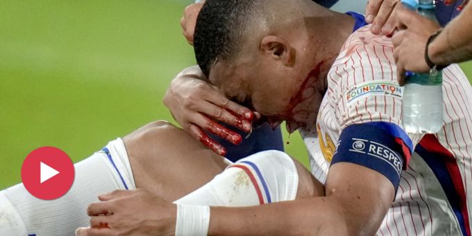 Nasenbeinbruch - Franzosen während Gruppenphase ohne Superstar Mbappé?