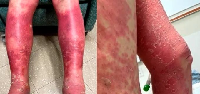 So sah die Haut des 74-jährigen nach seiner Coronavirus Impfung aus. Coronavirus
