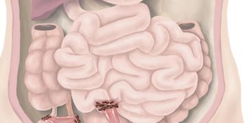 Endometriose Gebärmutterschleimhaut
