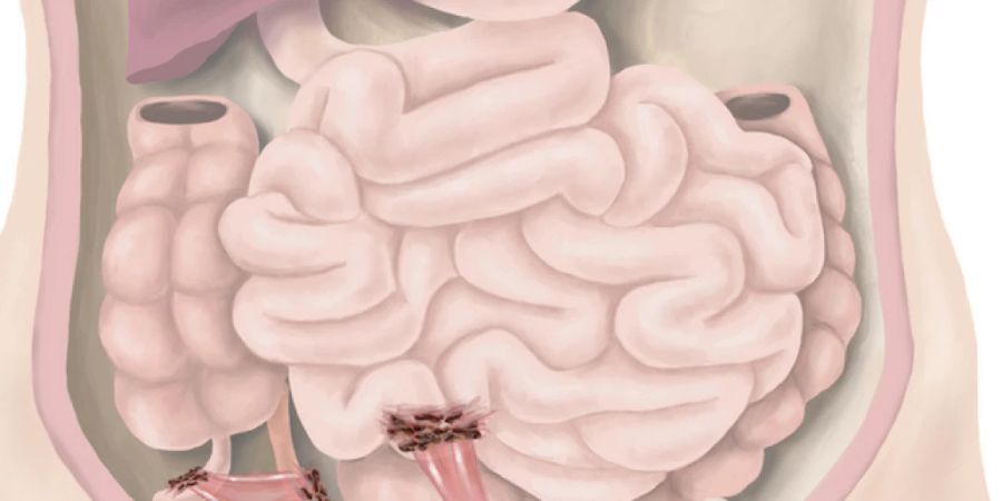 Endometriose Gebärmutterschleimhaut