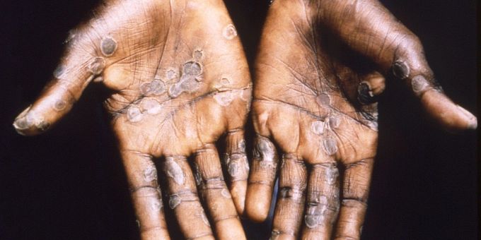 Die Handflächen eines Affenpockenpatienten zeigen einen Ausschlag. Affenpocken