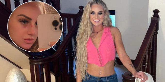 Im Training geholt? - Autsch! Alisha Lehmann zeigt blaues Auge