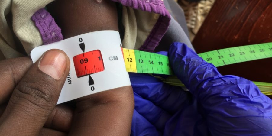 ARCHIV - Ein Arzt misst den Armumfang eines unterernährten Babys. Die rote Markierung bedeutet: Das Kind ist schwer unterernährt und braucht dringend Spezialnahrung. Foto: Eva-Maria K...