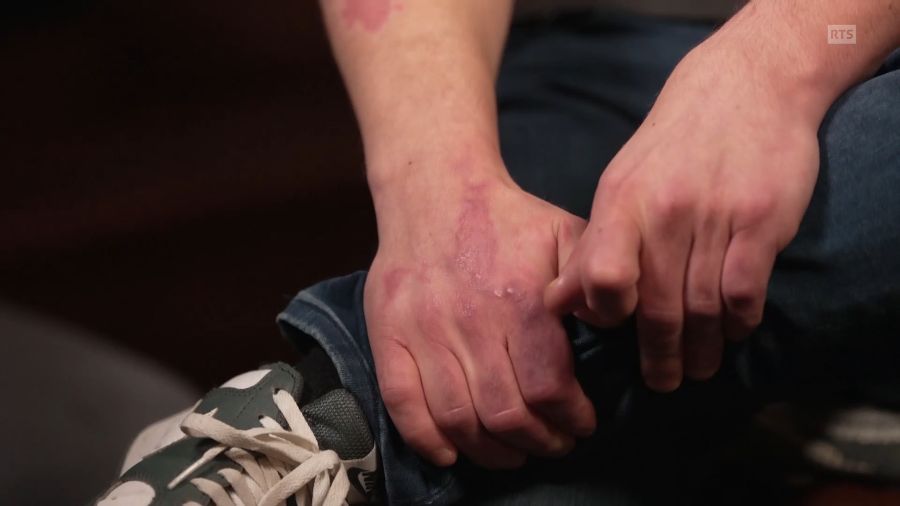 Auch an seinen Händen hat das Feuer seine Spuren hinterlassen.