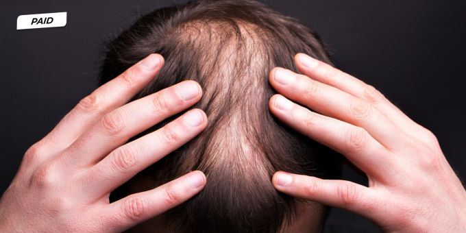 Männergesundheit - Haarausfall stoppen: Schweizer Lösung wirkt