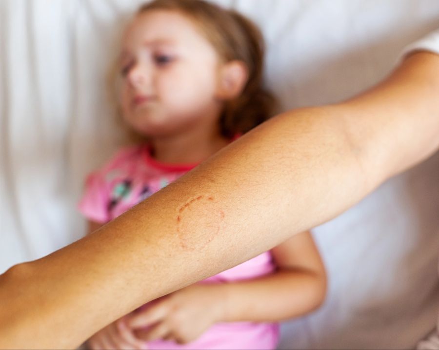 Arm einer Person mit Biss, Kind im Hintergrund