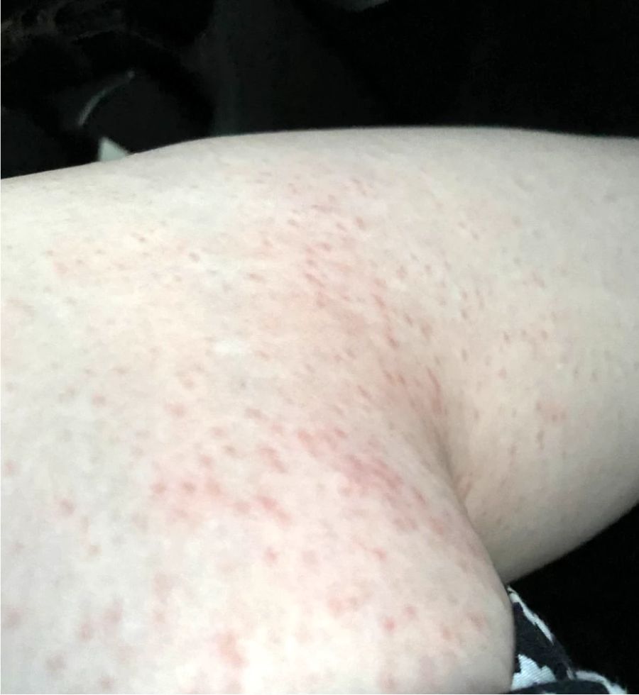 Die Beine der Leserin, nachdem sie Sonnencreme aufgetragen hatte.