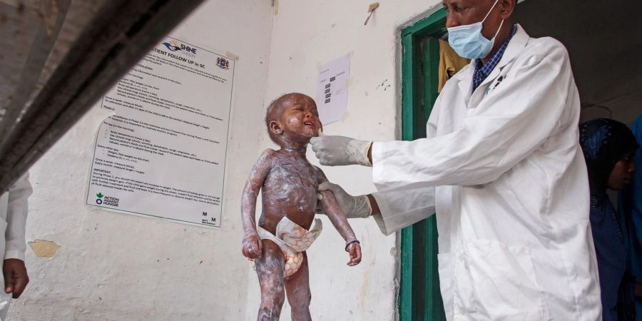 Ein Arzt im somalischen Mogadischu behandelt ein Kind, das Symptome einer schweren Eiweissunterernährung zeigt. In der von einer massiven Dürre gebeutelten Region ist es bereits zu ersten Todesfällen gekommen.
