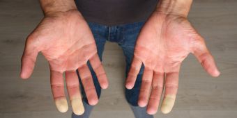 raynaud syndrom