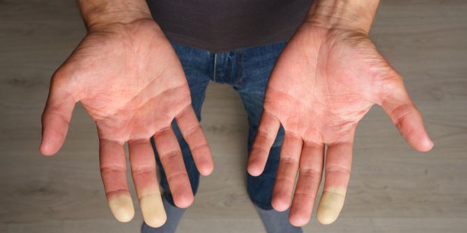 raynaud syndrom