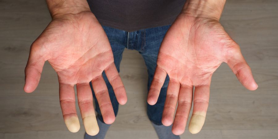raynaud syndrom