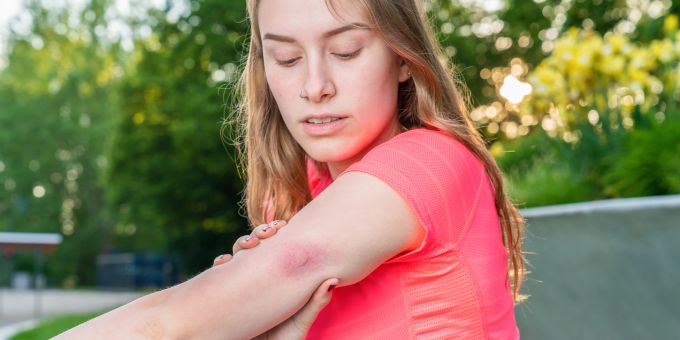 Bei Mückenstichen - Soforthilfe gegen Juckreiz und Schwellung