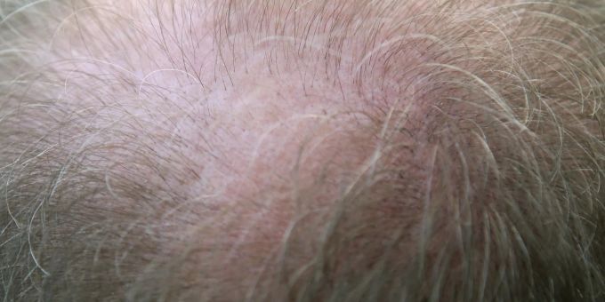 Erbgut - Diese Genvarianten verursachen Haarausfall bei Männern