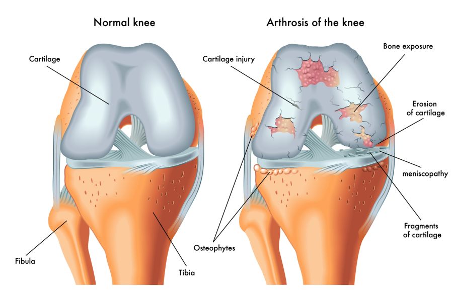 Gelenk Grafik Knochen Knie
