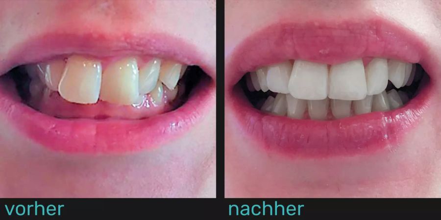Zähne vor und nach Gebrauch der durchsichtigen Zahnspange.