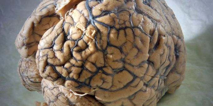 Genfer Wissenschaftler haben Immunzellen entwickelt, die speziell Glioblastome angreifen und dabei gesundes Gewebe schützen sollen. Klinische Studien sind in Planung. (Symbolbild) Gehirn des Menschen in einem Labor