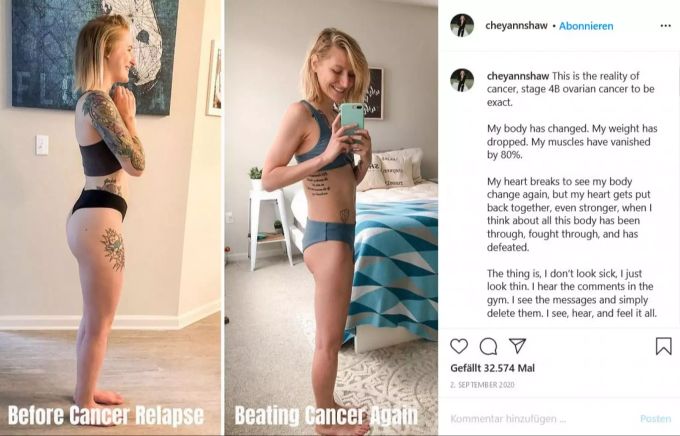 Cheyann Shaw, Influencerin, zeigt ihren Körper vor und nach dem Krebs. cheyann shaw influencerin