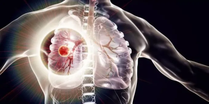 Aspirin Wirkt Als Heilmittel Gegen Tuberkulose