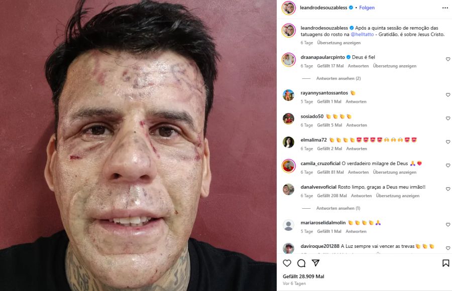 Nicht mehr von Tattoos, sondern vom Laser gezeichnet – nach der fünften Sitzung sind die Spuren deutlich sichtbar.