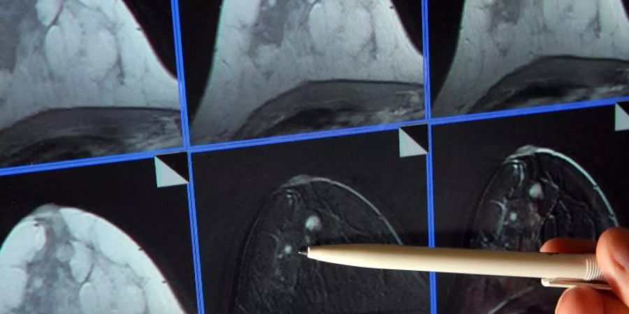 Auf einer Magnetresonanz-(MR)-Mammographie ist ein winziger Tumor in der Brust einer Patientin zu sehen. Foto: Jan-Peter Kasper