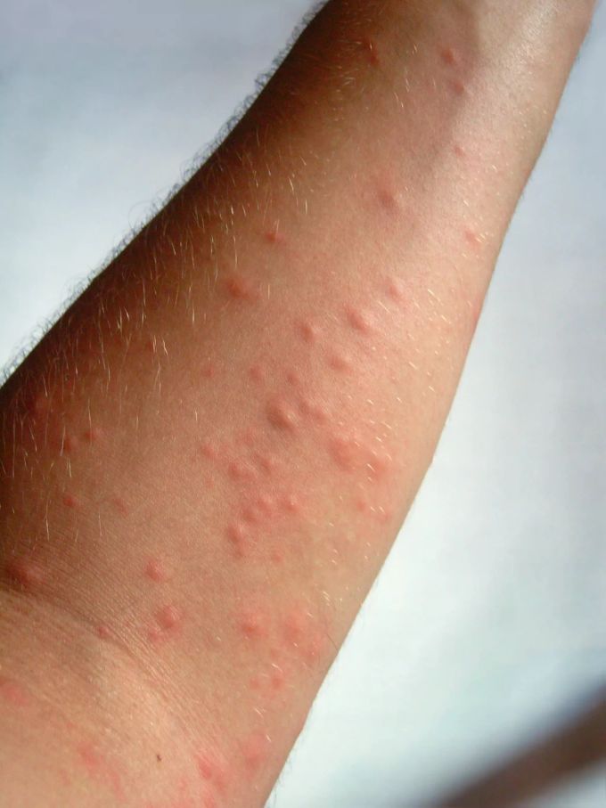 Eine Raupendermatitis am Unterarm. Raupe Oppligen