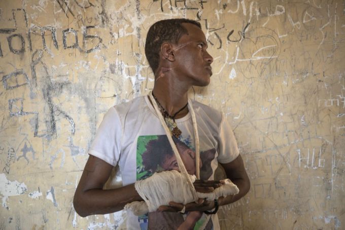 Ein mutmassliches Opfer der Fano-Miliz zeigt seine Verletzungen. (Archivbild) Fano Miliz Amhara-Region