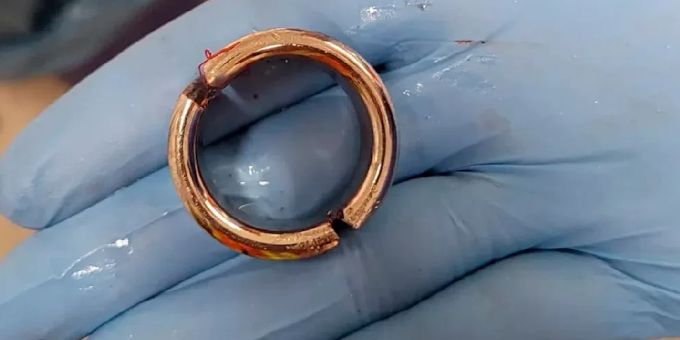 Diesen Penis-Ring musste die Feuerwehr dem Mann abnehmen. Penis-Ring