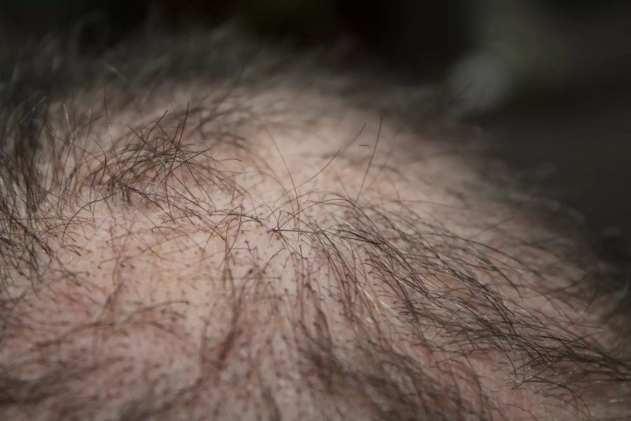 Haarausfall Therapie