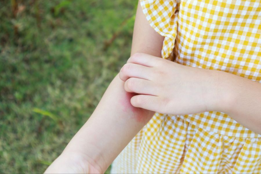 Mädchen kratzt sich am Arm