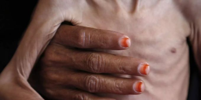 Eine Frau hält ein unterernährtes Kind in einem Krankenhaus in der Provinz Hadscha. Eine Frau hält ein unterernährtes Kind in einem Krankenhaus in der Provinz Hadscha.