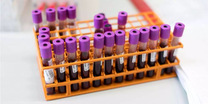 Die WHO ruft zu mehr frühen Hepatitis-Tests im Blut auf. Hepatitis bei Kindern sorgt für Unklarheit