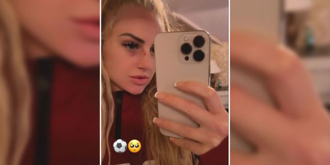 Alisha Lehmann teilt ein Bild von ihrer Blessur mit ihren über sieben Millionen Insta-Followern. Alisha Lehmann