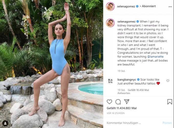 Selena Gomez zeigt ihre OP- Narben. selena gomez