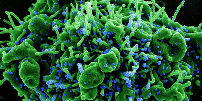 Mikroskopaufnahme einer menschlichen Zelle (grün), die mit Coronavirus-Partikeln (blau) infiziert ist. (Archivbild) corona