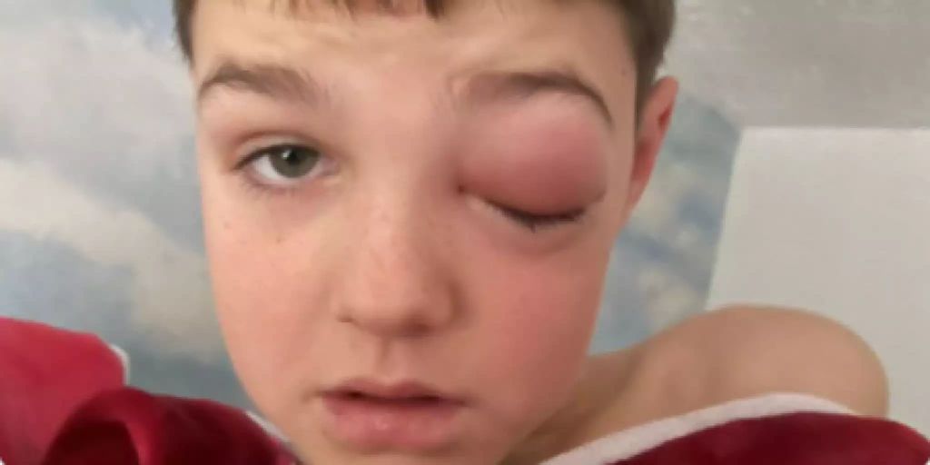 The boy (9) gets corona eye and becomes almost blind