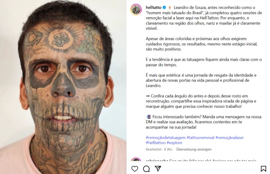 Bis vor Kurzem war Leandro de Souzas Gesicht noch komplett tätowiert. Nun unterzieht er sich einer aufwendigen Laserbehandlung – 170 Tattoos sollen verschwinden.
