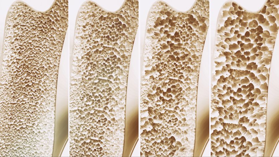 Knochenschwund Osteoporose Mittel Heilung