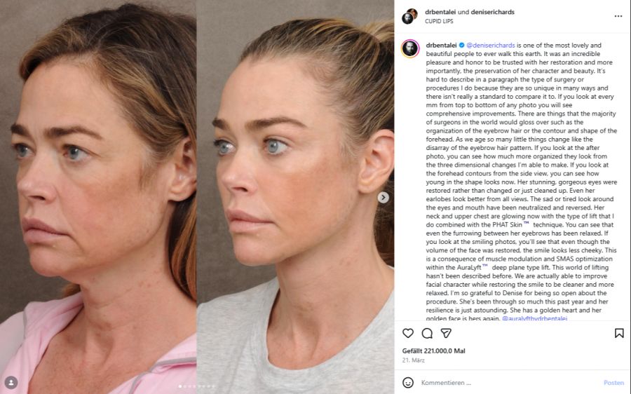 Ende März 2026 präsentierte Denise Richards den Vorher-Nachher-Vergleich ihres Facelifts.