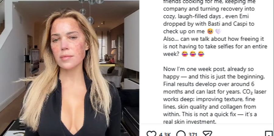 Dieses Mal sei sie wegen der sichtbaren Nachwirkungen der Behandlung länger ausgefallen als beim letzten Mal.