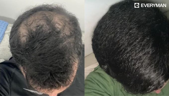 4 von 5 Männer sehen eine deutliche Verbesserung ihres Haarwachstums. Everyman Health