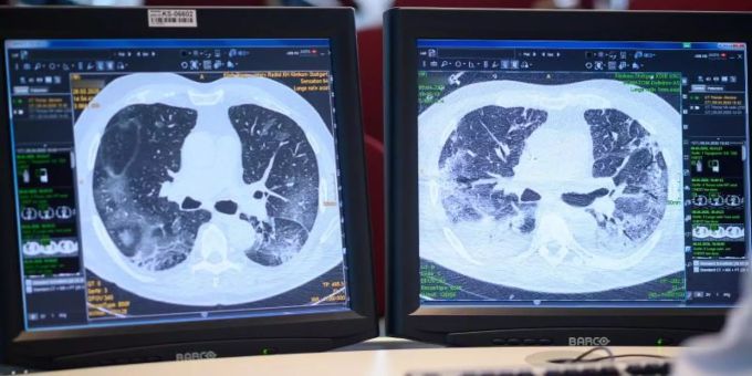 Auf zwei Monitoren sind am Klinikum Stuttgart Computertomographieaufnahmen der Lunge eines Covid-19-Patienten zu sehen. Foto: Sebastian Gollnow/dpa Auf zwei Monitoren sind am Klinikum Stuttgart Computertomographieaufnahmen der Lunge eines Covid-19-Patienten zu sehen. Foto: Sebastian Gollnow/dpa