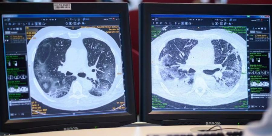 Auf zwei Monitoren sind am Klinikum Stuttgart Computertomographieaufnahmen der Lunge eines Covid-19-Patienten zu sehen. Foto: Sebastian Gollnow/dpa